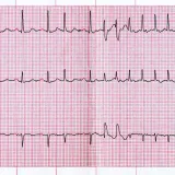 Managing Atrial Fibrillation in Primary Care