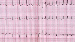 Managing Atrial Fibrillation in Primary Care