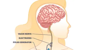 Calming the Nervous System: How Vagus Nerve Stimulation Can Help Ease Anxiety
